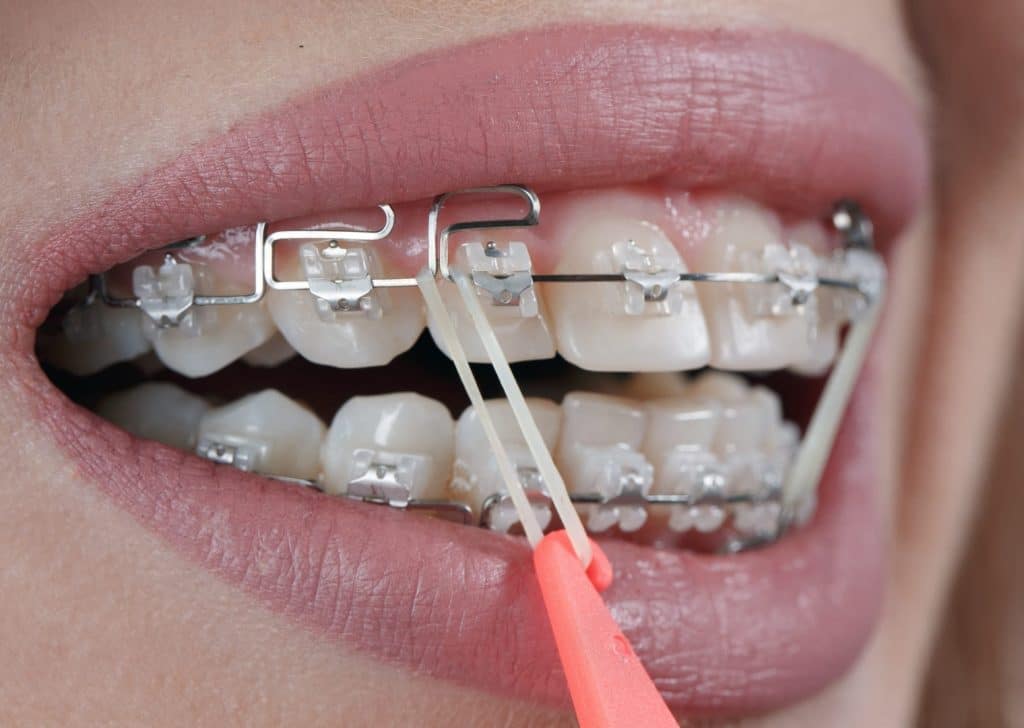 QUE FAIRE SI… je n’ai plus d’élastiques ?