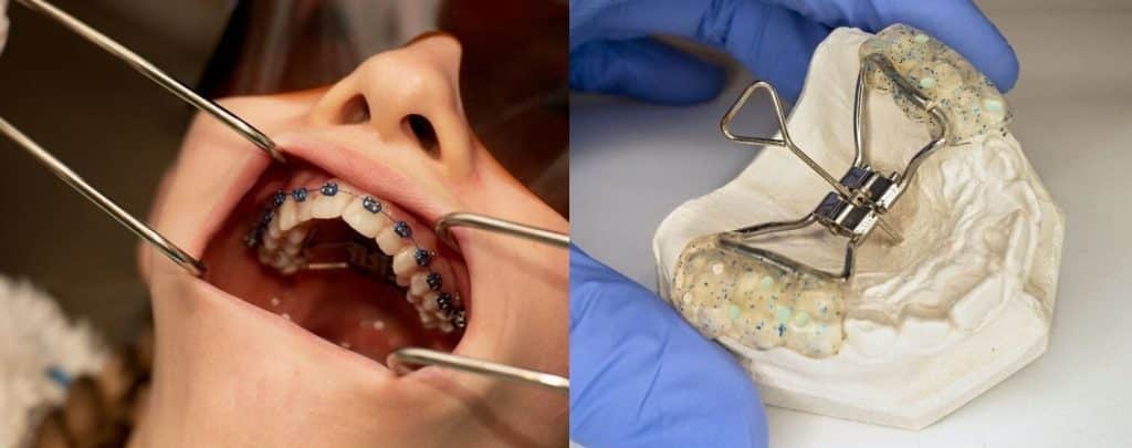 Bénéfices d’un traitement précoce pour le développement des mâchoires