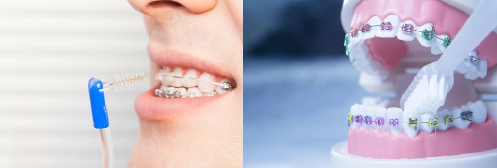 l'hygiène avec un appareil dentaire est vitale